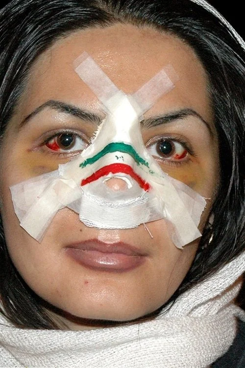 عمل بینی به سبک ایرانی