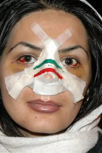 عمل بینی به سبک ایرانی