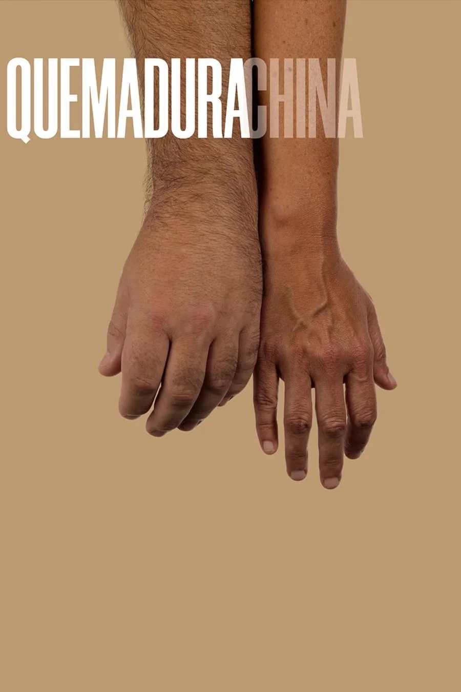 سوختگی چینی